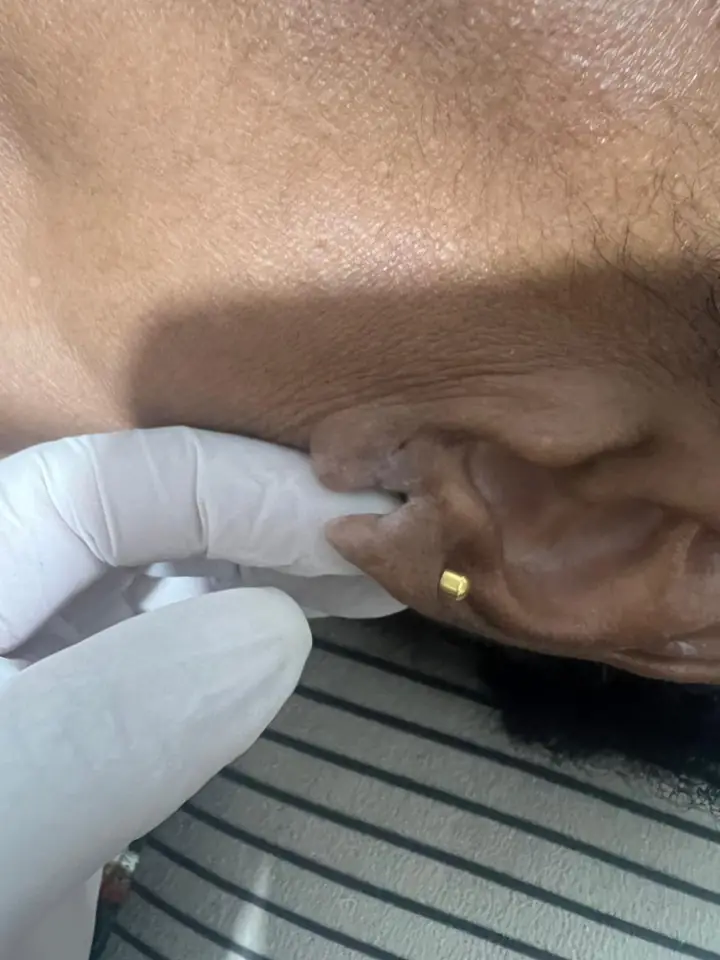 Lóbulo da orelha rasgado antes da lobuloplastia não cirúrgica