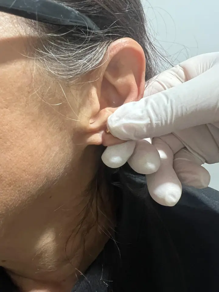 Resultado de correção de lóbulo rasgado sem cirurgia