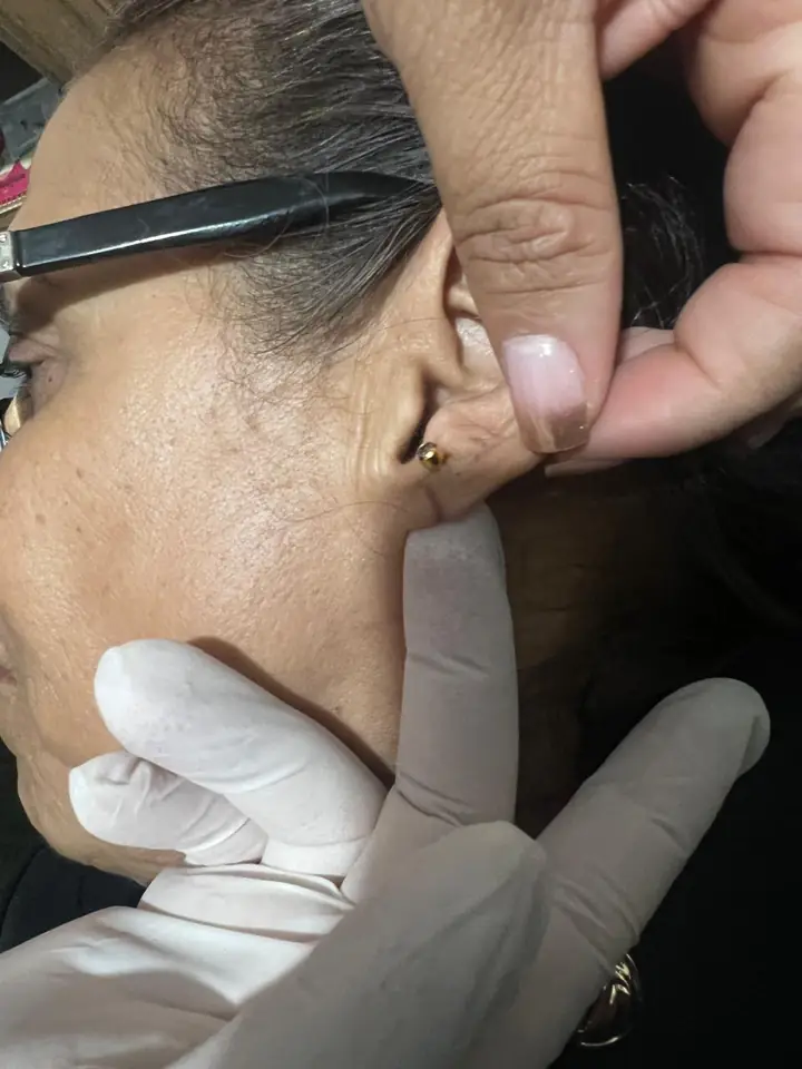 Resultado de lobuloplastia não cirúrgica em Sua Cidade
