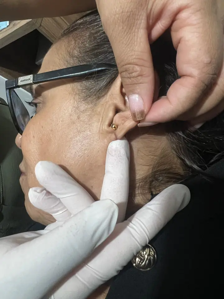 Lobuloplastia sem cortes, brinco no lugar