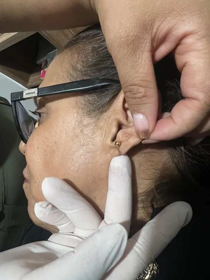 Lobuloplastia não cirúrgica: lóbulo fechado e com joia